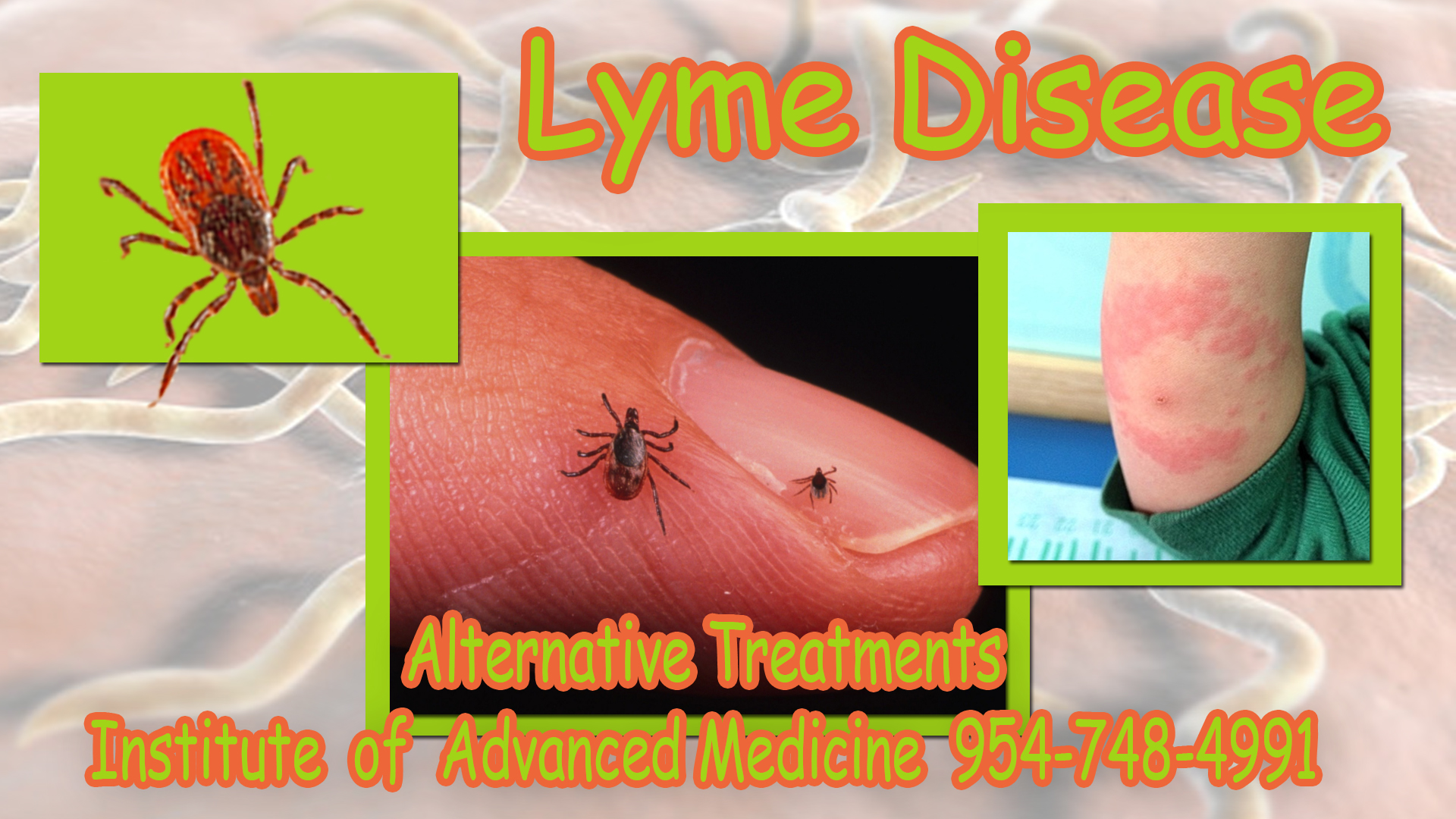 Lyme Disease 